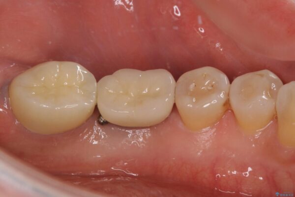 しみる奥歯　オールセラミッククラウンによる補綴治療 治療後画像