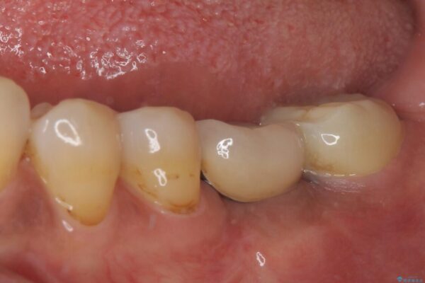 しみる奥歯　オールセラミッククラウンによる補綴治療 治療後画像