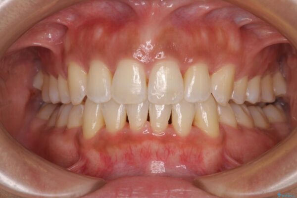 抜歯矯正で唇を閉じやすく　目立たないワイヤー装置 治療後画像