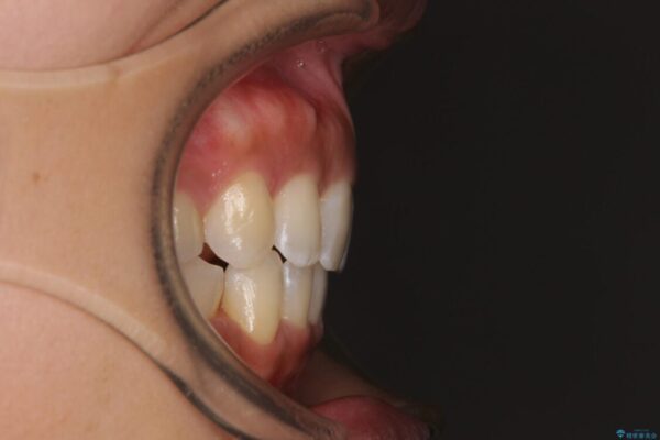 抜歯矯正で唇を閉じやすく　目立たないワイヤー装置 治療後画像