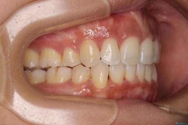 抜歯矯正で唇を閉じやすく　目立たないワイヤー装置 治療後画像