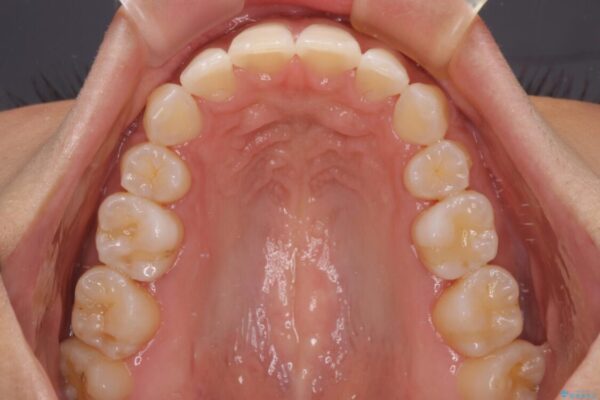 抜歯矯正で唇を閉じやすく　目立たないワイヤー装置 治療後画像