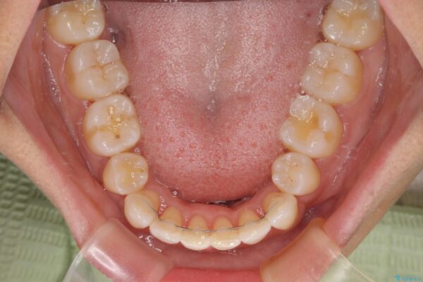 抜歯矯正で唇を閉じやすく　目立たないワイヤー装置 治療後画像