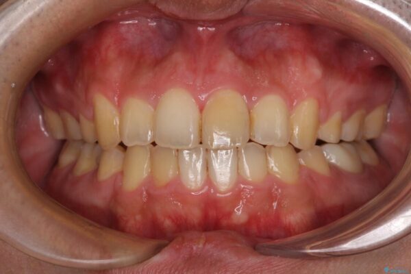 後戻りでデコボコの前歯　インビザライン矯正治療 治療後画像