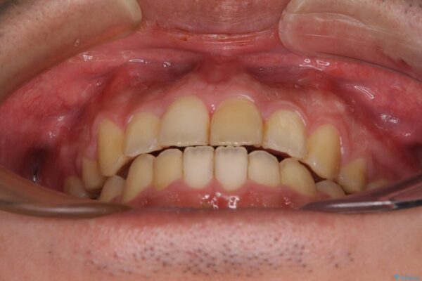 後戻りでデコボコの前歯　インビザライン矯正治療 治療後画像