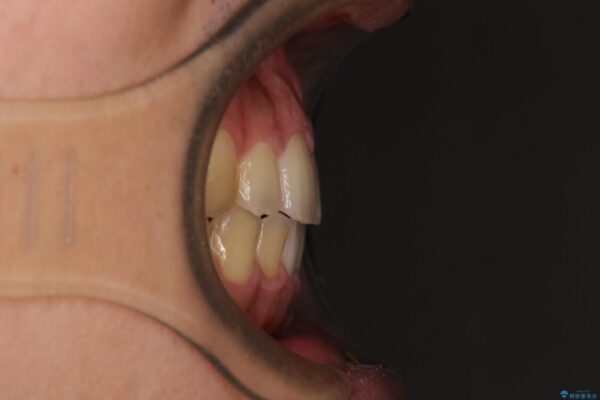 後戻りでデコボコの前歯　インビザライン矯正治療 治療後画像