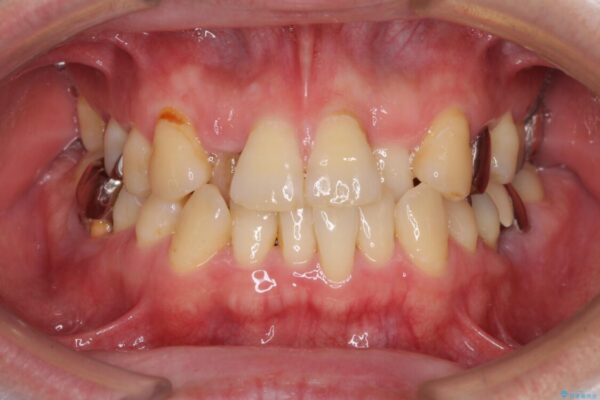 割れてしまった奥歯とデコボコの前歯　矯正治療とインプラント治療 ビフォー