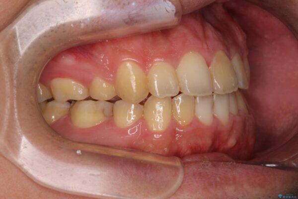 後戻りでデコボコの前歯　インビザライン矯正治療 治療後画像