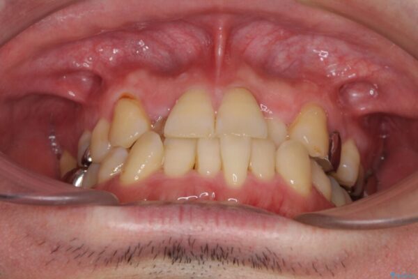 割れてしまった奥歯とデコボコの前歯　矯正治療とインプラント治療 治療前画像