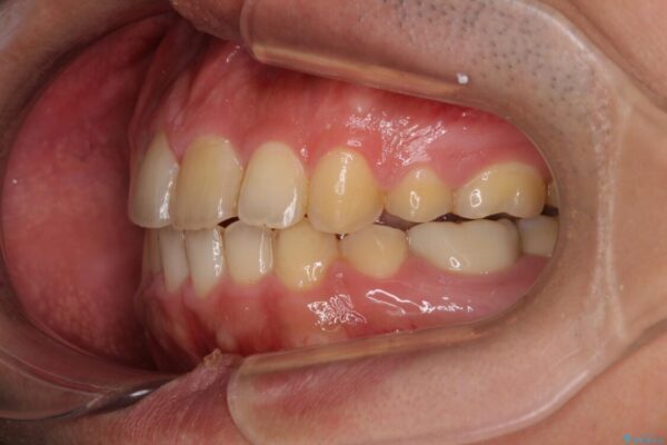 後戻りでデコボコの前歯　インビザライン矯正治療 治療後画像