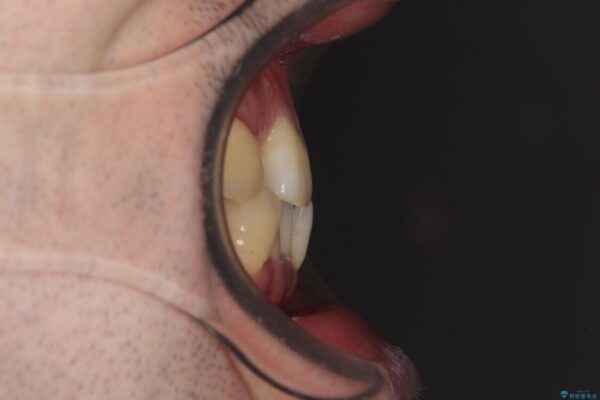 割れてしまった奥歯とデコボコの前歯　矯正治療とインプラント治療 治療前画像