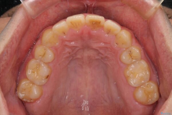 後戻りでデコボコの前歯　インビザライン矯正治療 治療後画像