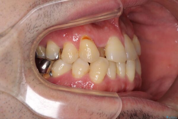 割れてしまった奥歯とデコボコの前歯　矯正治療とインプラント治療 治療前画像