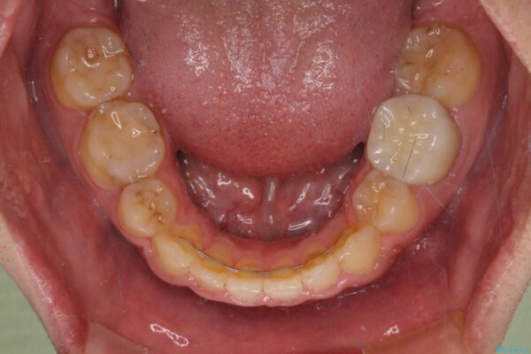 後戻りでデコボコの前歯　インビザライン矯正治療 治療後画像