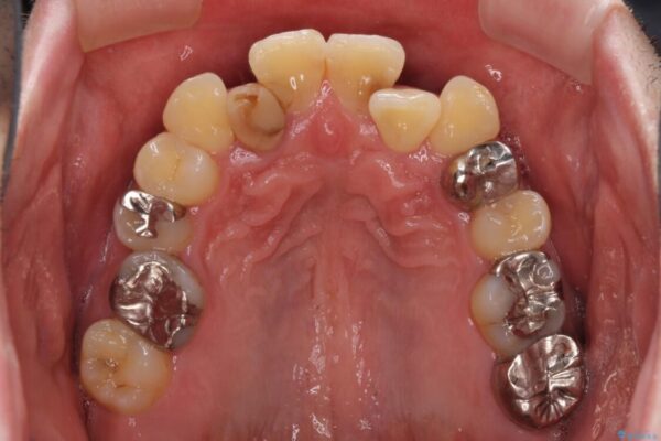 割れてしまった奥歯とデコボコの前歯　矯正治療とインプラント治療 治療前画像