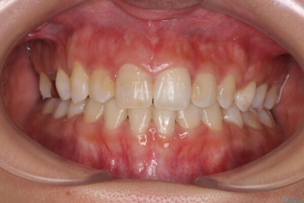 気になる八重歯　目立ちにくいハーフリンガルでの抜歯矯正 治療後画像