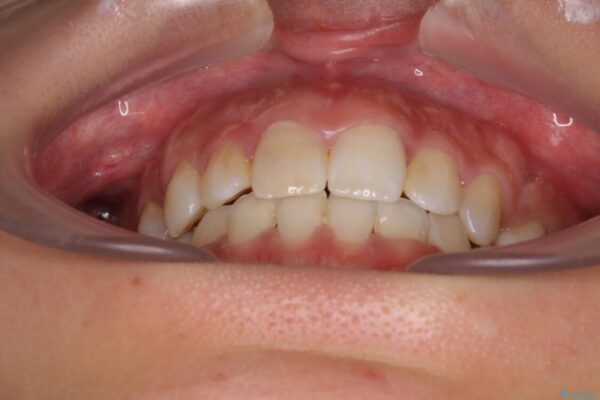 気になる八重歯　目立ちにくいハーフリンガルでの抜歯矯正 治療途中画像