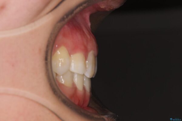気になる八重歯　目立ちにくいハーフリンガルでの抜歯矯正 治療後画像