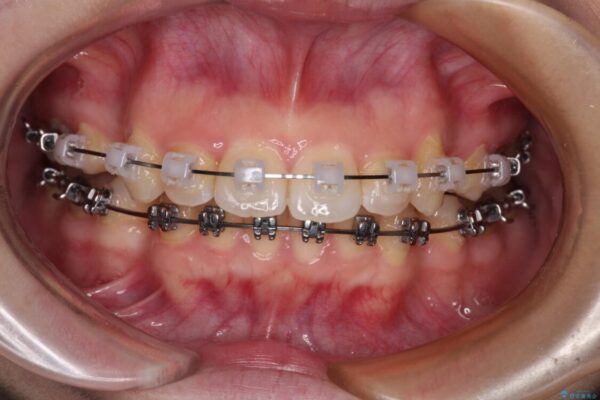 【モニター】口が閉じられない　ワイヤー装置での抜歯矯正 治療途中画像
