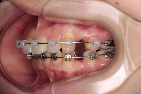 【モニター】口が閉じられない　ワイヤー装置での抜歯矯正 治療途中画像