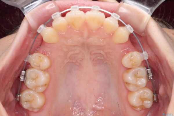 【モニター】口が閉じられない　ワイヤー装置での抜歯矯正 治療途中画像