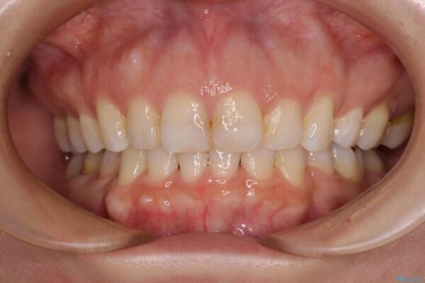 【モニター】出っ歯と咬み合わせを改善　ワイヤー装置の抜歯矯正 治療後画像