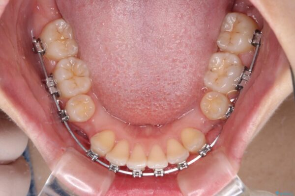 【モニター】口が閉じられない　ワイヤー装置での抜歯矯正 治療途中画像