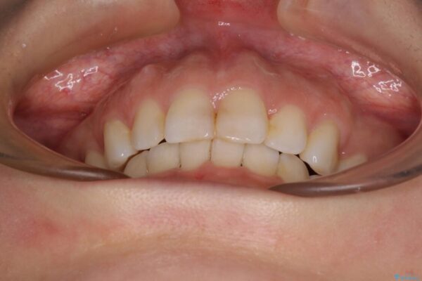 【モニター】出っ歯と咬み合わせを改善　ワイヤー装置の抜歯矯正 治療後画像