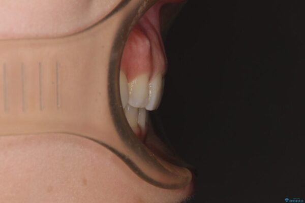 【モニター】出っ歯と咬み合わせを改善　ワイヤー装置の抜歯矯正 治療後画像