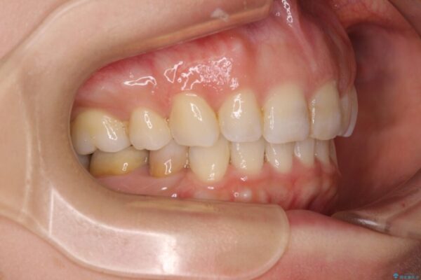 【モニター】出っ歯と咬み合わせを改善　ワイヤー装置の抜歯矯正 治療後画像