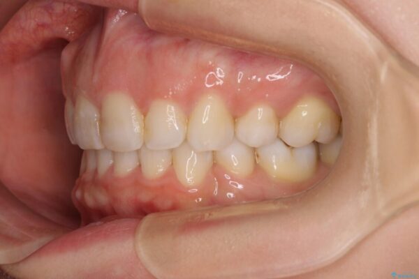 【モニター】出っ歯と咬み合わせを改善　ワイヤー装置の抜歯矯正 治療後画像