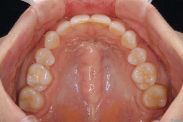 【モニター】出っ歯と咬み合わせを改善　ワイヤー装置の抜歯矯正 治療後画像