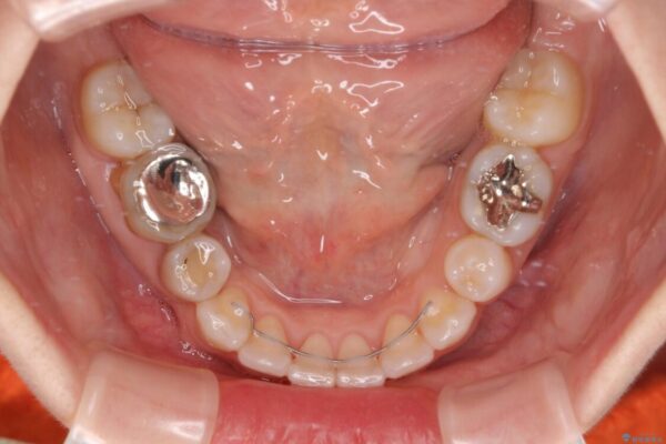 【モニター】出っ歯と咬み合わせを改善　ワイヤー装置の抜歯矯正 治療後画像