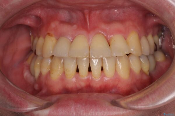 割れてしまった奥歯とデコボコの前歯　矯正治療とインプラント治療 アフター