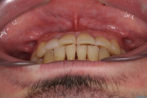 割れてしまった奥歯とデコボコの前歯　矯正治療とインプラント治療 治療後画像