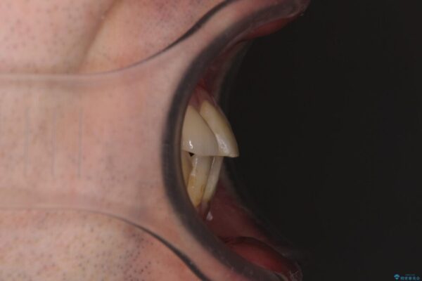 割れてしまった奥歯とデコボコの前歯　矯正治療とインプラント治療 治療後画像