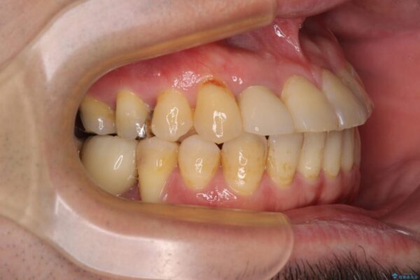 割れてしまった奥歯とデコボコの前歯　矯正治療とインプラント治療 治療後画像