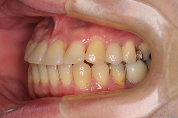 割れてしまった奥歯とデコボコの前歯　矯正治療とインプラント治療 治療後画像