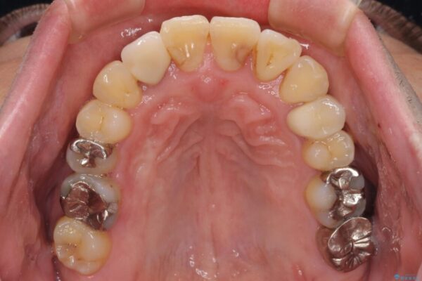 割れてしまった奥歯とデコボコの前歯　矯正治療とインプラント治療 治療後画像