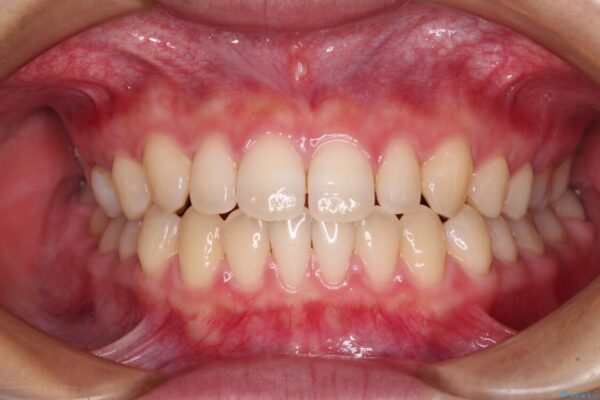 隙間だらけの歯列　インビザラインで改善 治療途中画像