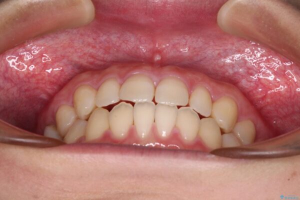 隙間だらけの歯列　インビザラインで改善 治療途中画像