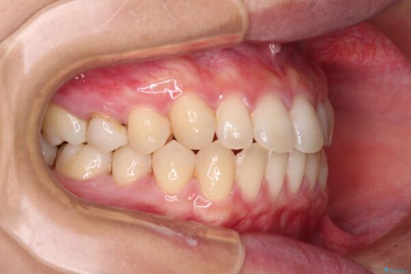 隙間だらけの歯列　インビザラインで改善 治療途中画像