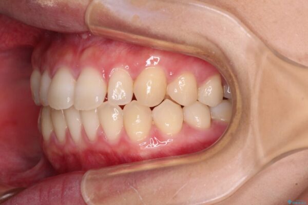 隙間だらけの歯列　インビザラインで改善 治療途中画像
