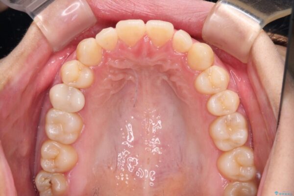 隙間だらけの歯列　インビザラインで改善 治療途中画像