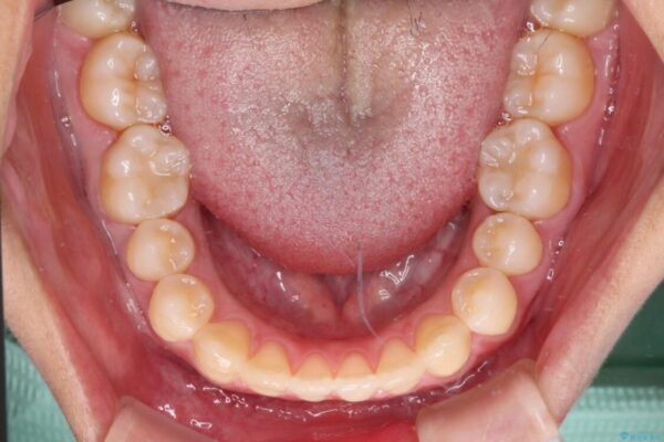 隙間だらけの歯列　インビザラインで改善 治療途中画像
