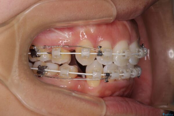 抜歯矯正で唇を閉じやすく　目立たないワイヤー装置 治療途中画像