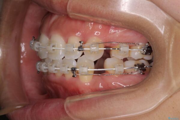 抜歯矯正で唇を閉じやすく　目立たないワイヤー装置 治療途中画像