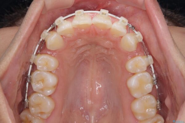 抜歯矯正で唇を閉じやすく　目立たないワイヤー装置 治療途中画像