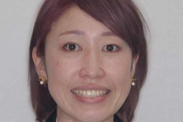 【モニター】カリエール・ディスタライザーを併用した八重歯のインビザライン矯正 治療後画像