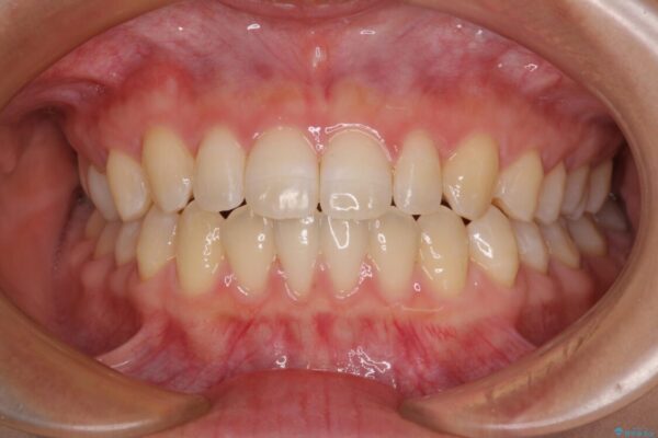 隙間だらけの歯列　インビザラインで改善 治療後画像